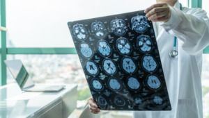 Concussions are Silent Injuries with a Life-threatening Impact